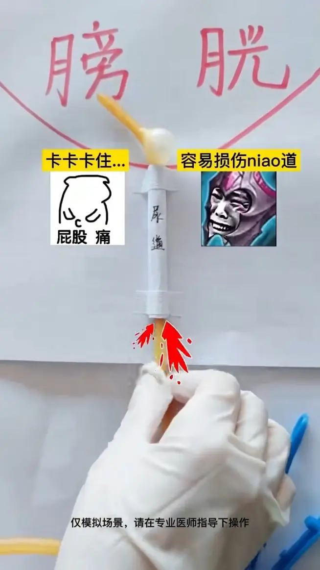 模拟 拽出导尿管有多痛?