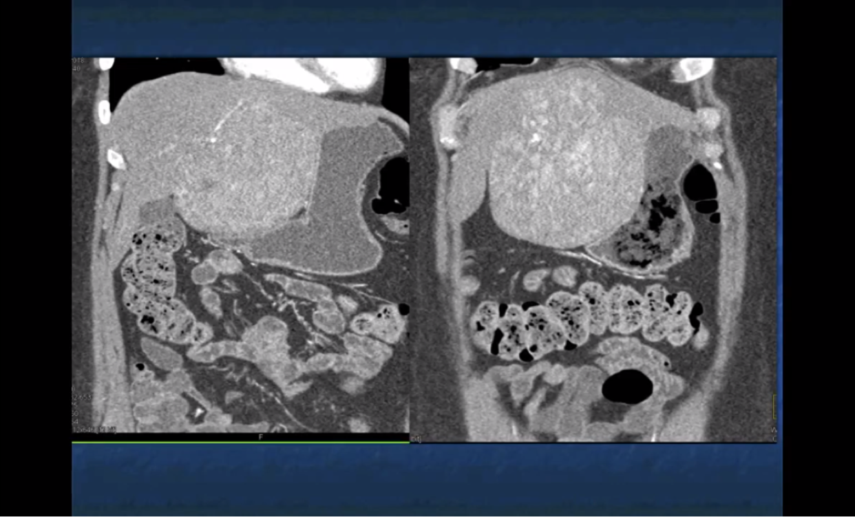 1310:1913肝腺瘤是一个诊断难点!