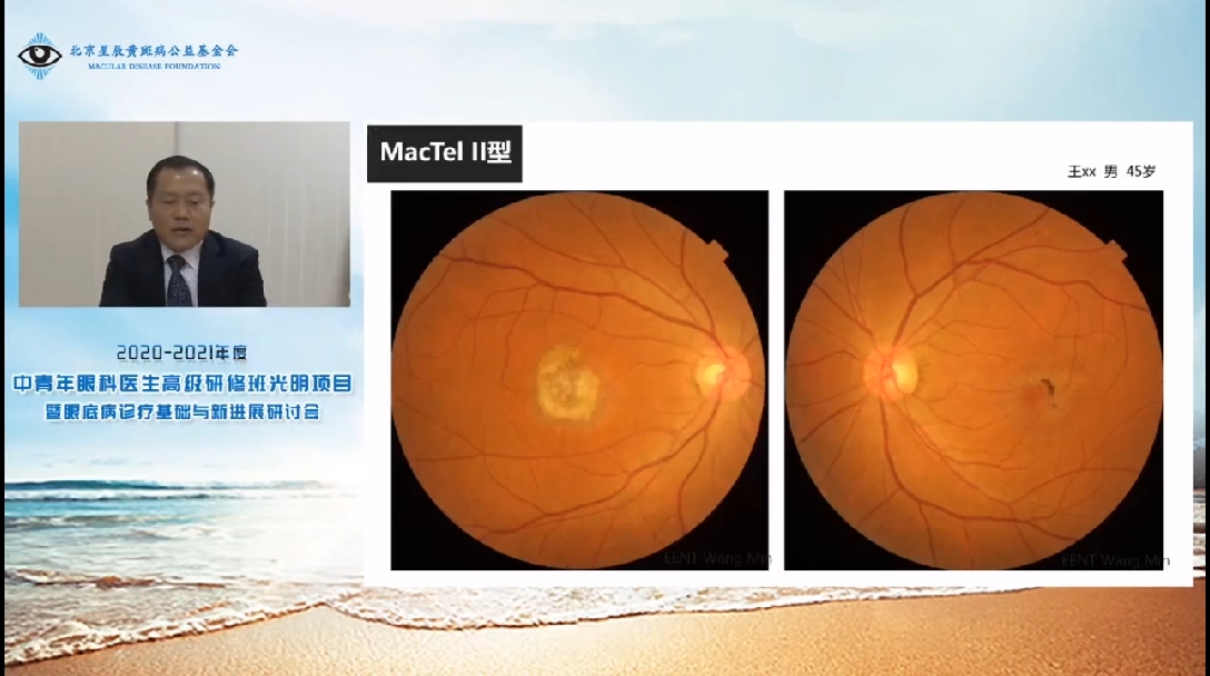 可见视盘上的新生血管中和大血管层的血流速度快,有很多黑色区域的流