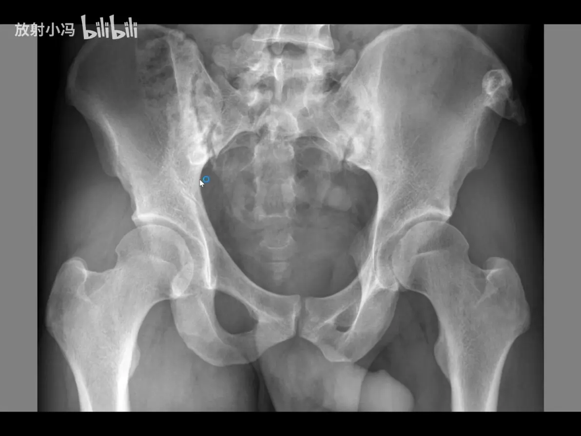 骨盆x线平片的判读方法