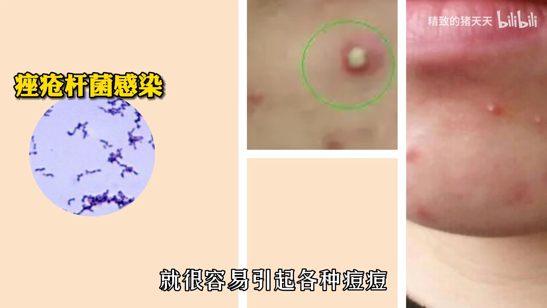 痘痘反复长?小心烂脸!“拯救烂脸三部曲”快接收!️快速解决顽固痘根 - 哔哩哔哩