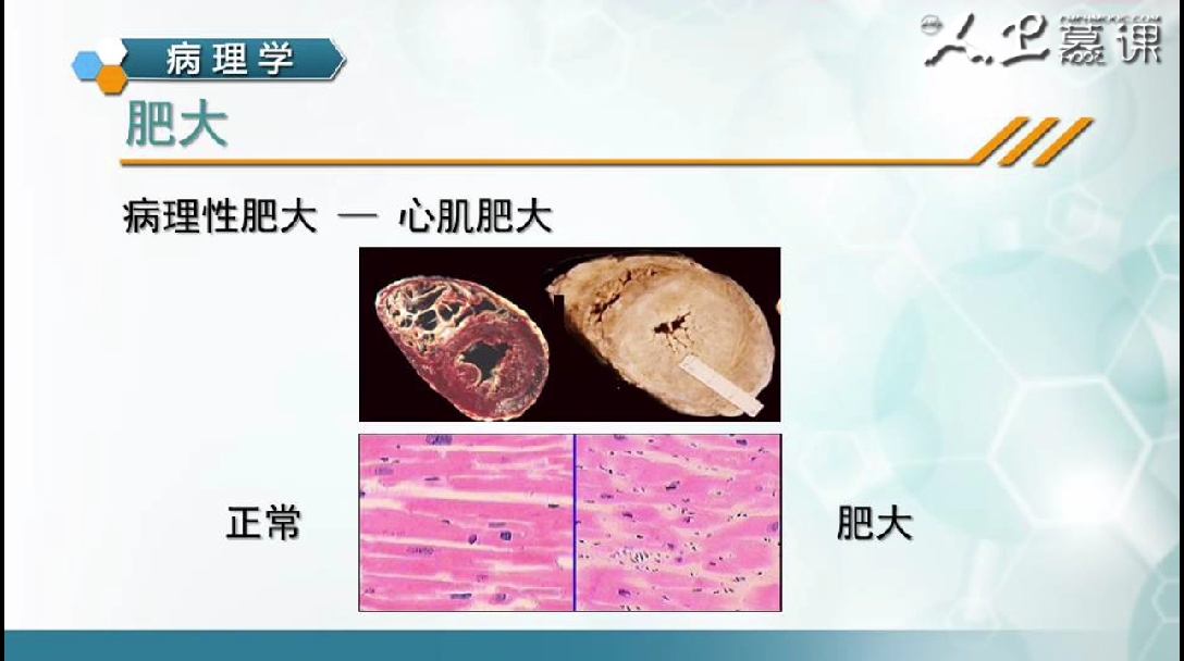 8-1公分 肥大心肌:1.5-2公分 心腔狭小增生:原因:1.