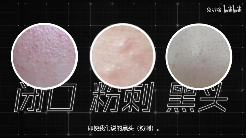属于一级非炎症性皮损③黑头:白头暴露时间长,氧化②粉刺:闭口出来,冒