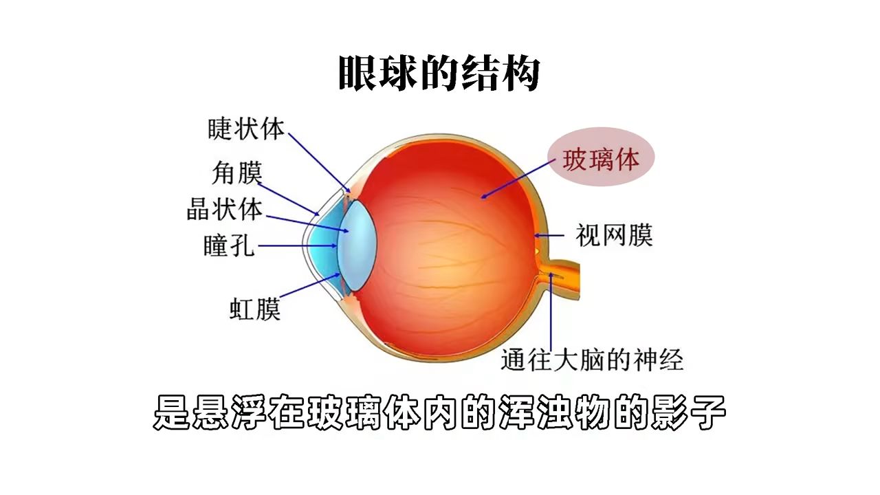 你眼前的漂浮物是悬浮在玻璃体内的浑浊物的眼睛,当眼球移动时,漂浮物