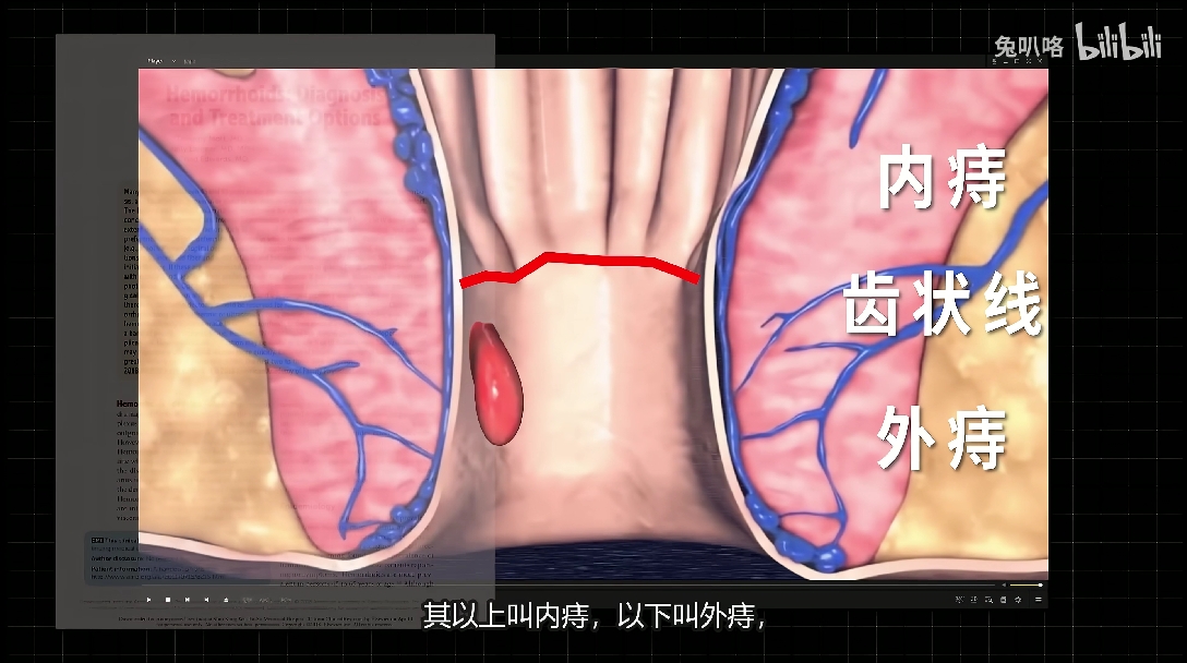 ③上下都有为混合痔②齿状线以下为外痔①齿状线以上为内痔2,痔疮分类