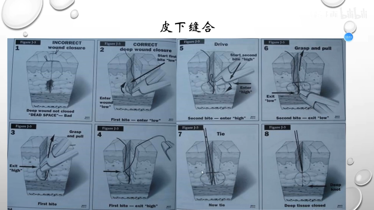 最全缝合讲解合集