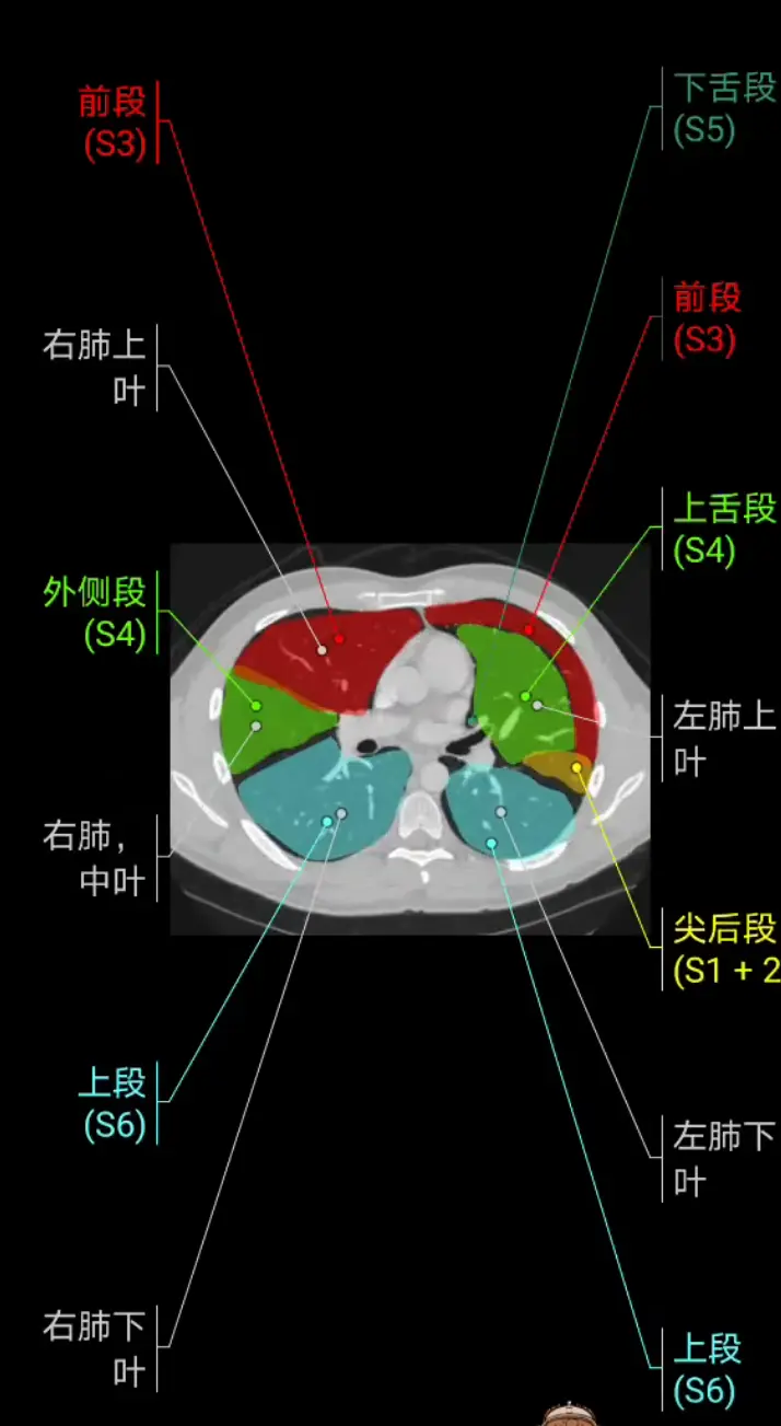 左肺上叶:s1 2:尖后段;s3:前段;s4:上舌段/舌叶