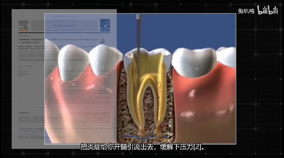 i 牙痛如何快速緩解? - 嗶哩嗶哩