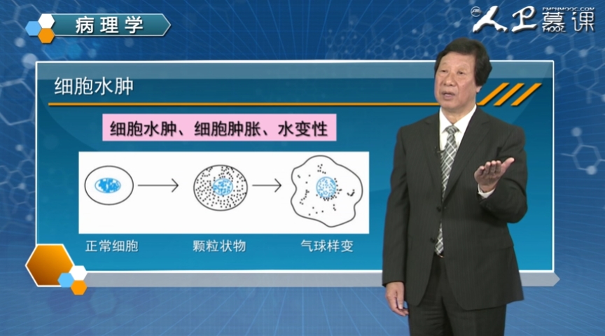 一塊水腫的肝臟 :濁腫肝臟正常肝臟細胞排列整齊 氣球樣變肉眼觀察