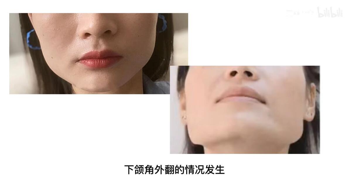 咬肌型方脸！一个动作让你摆脱顽固咬肌！ - 哔哩哔哩